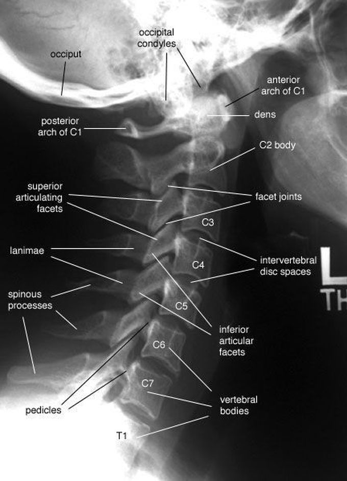 Xray cervical spine