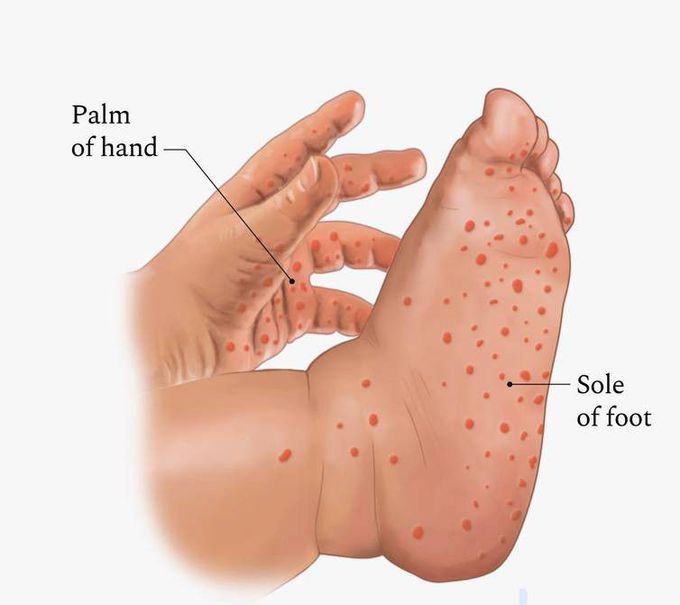 Symptoms of coxsackie virus