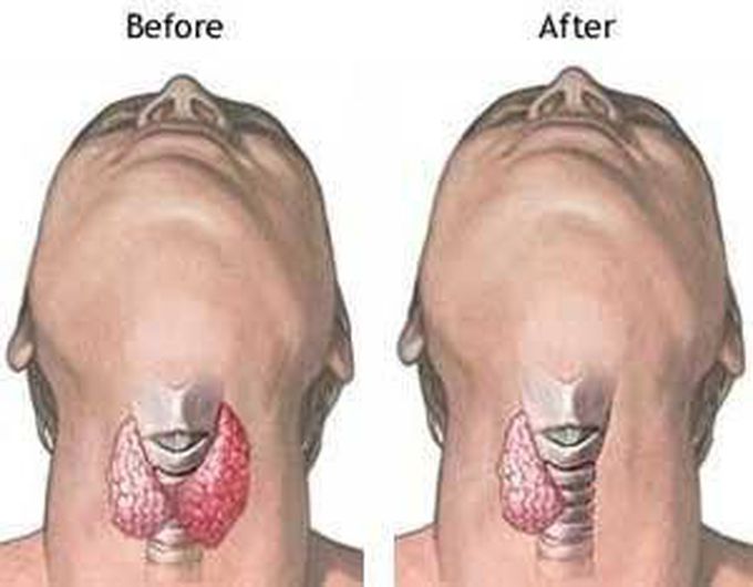 Thyroid Lobectomy