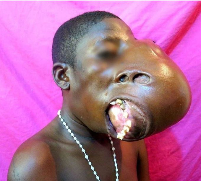 Extreme Case Of Craniofacial Fibrous Dysplasia