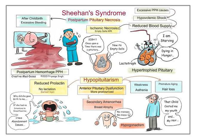 Sheehan's Syndrome