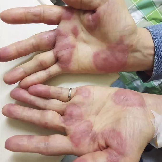 Rheumatoid Arthritic Patient having sweet's Syndrome.