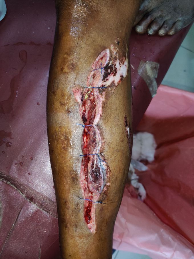 Deep Laceration on Leg