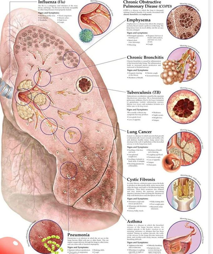 Disease of the lungs