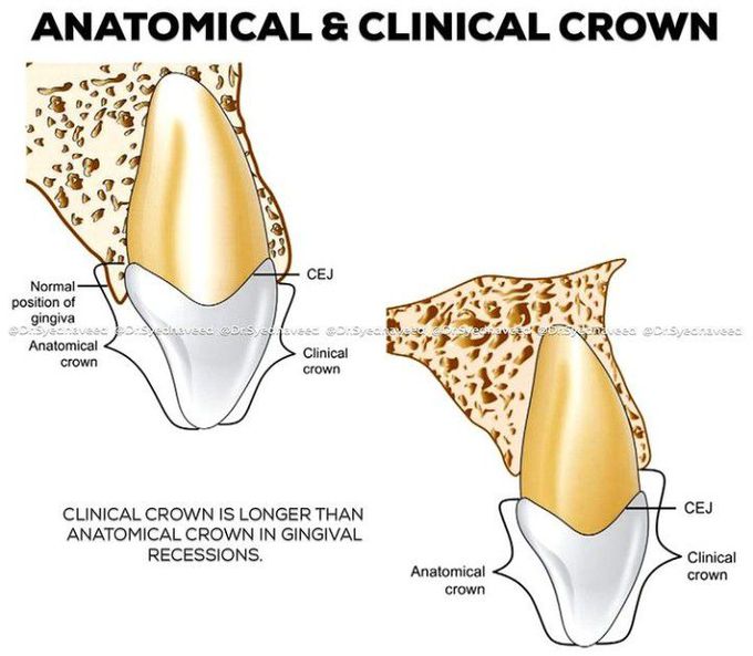 Anatomical Vs Clinical Crown