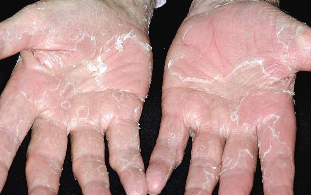 wrinkly skin syndrome