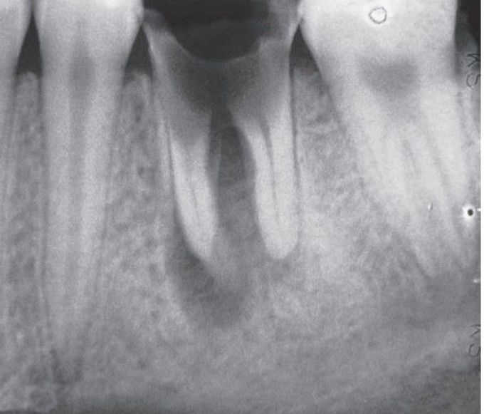 Periapical cyst associated with a carious tooth.