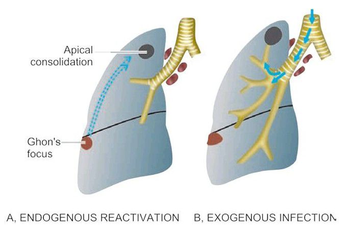 Progressive secondary tuberculosis