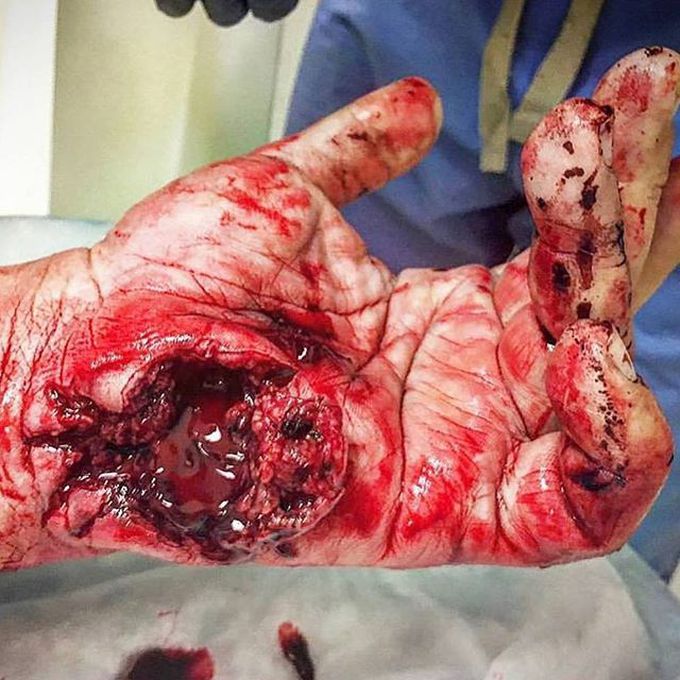 Gun accident