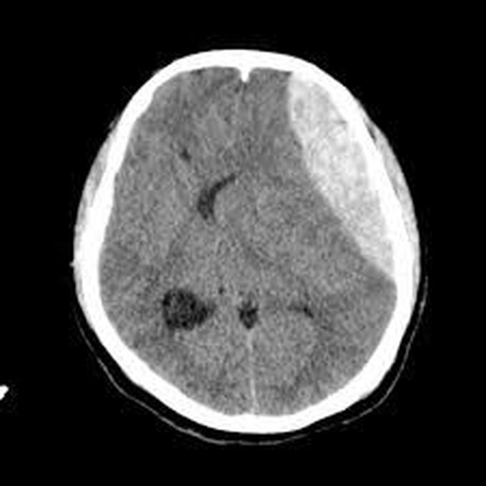 Epidural hematoma treatment