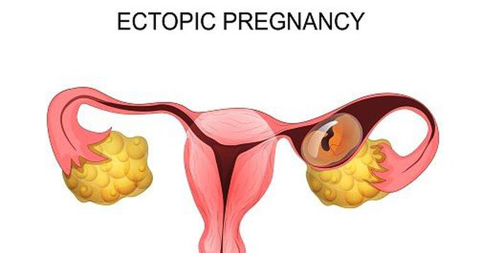 What is an ectopic pregnancy and how does it happen?