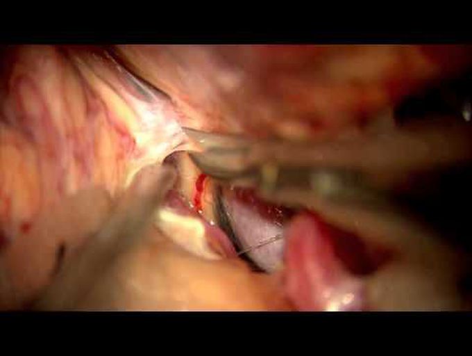 Clipping and STA-MCA bypass for unruptured AcomA aneurysm associated with unilateral MCA occlusion