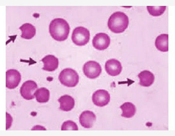 Identify cell? Seen in which condition??