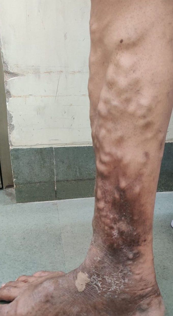 Varicose Veins
