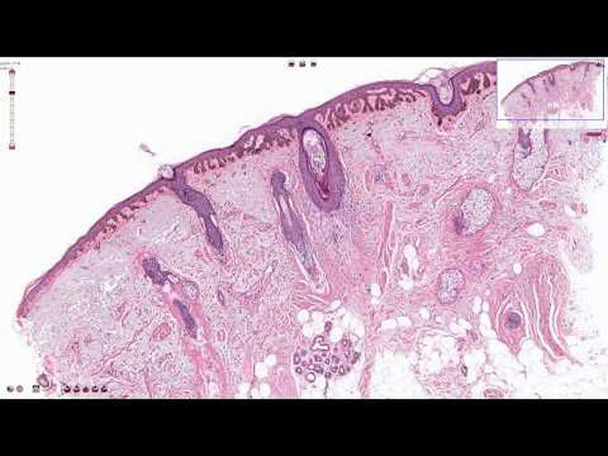 Skin pathology in form of solar lentigo