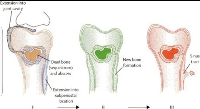 Osteomyelitis in action