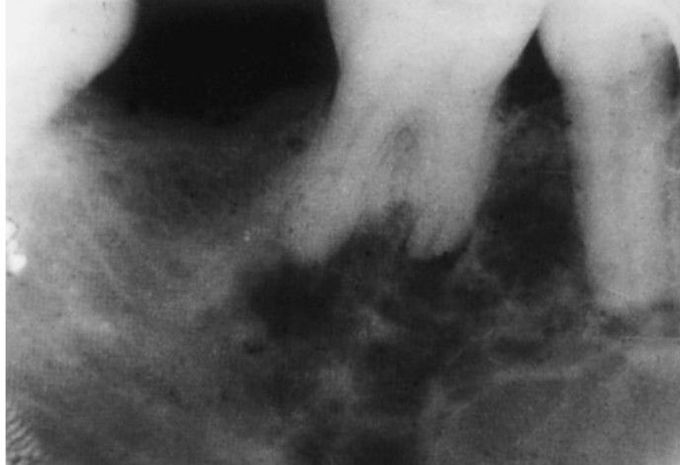 Ameloblastoma