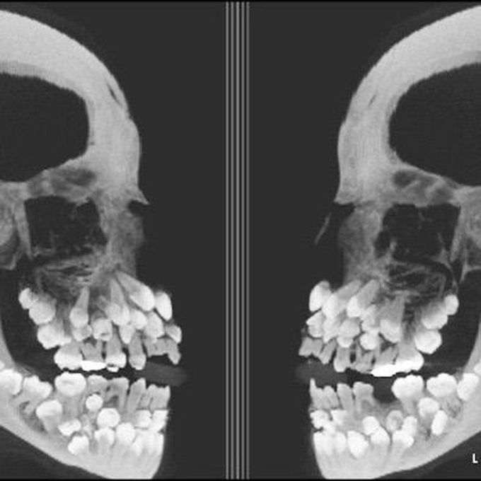 Hyperdontia