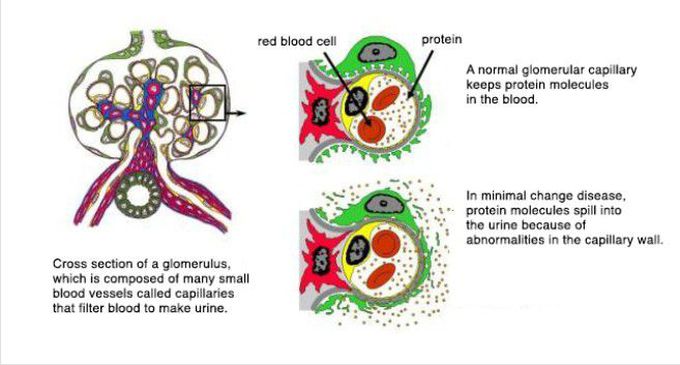 Minimal change disease