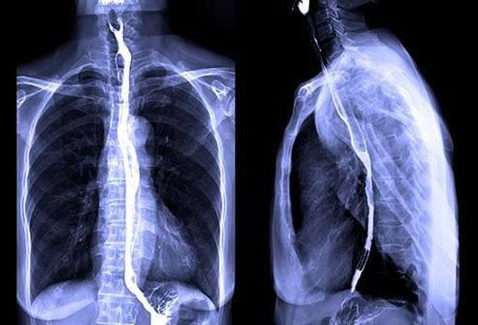 Barium swallow