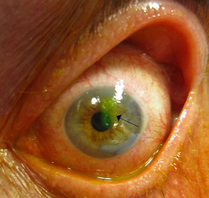 Corneal abrasion