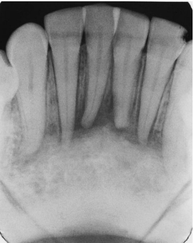 Bony adenocarcinoma