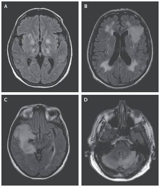 Encephalitis