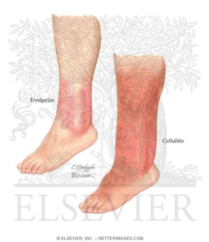 erysipelas vs cellulitis