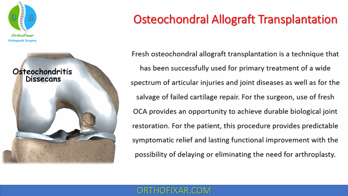 Osteochondral Allograft Transplantation â¢ Easy Explained - OrthoFixar 2022