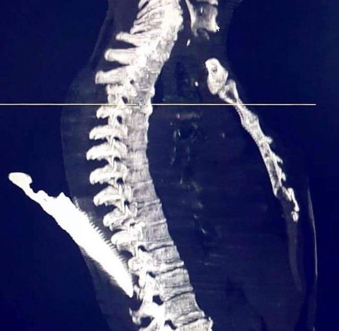 Stabbed by knife in fhw back.