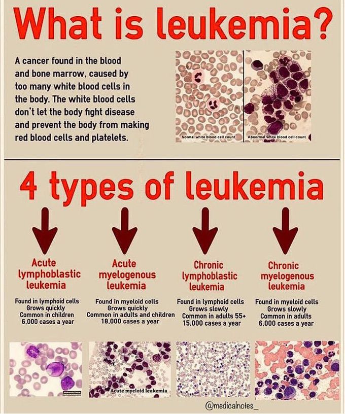 Leukemia types