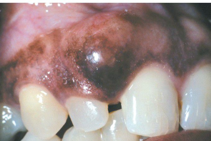 Peripheral Ameloblastoma.