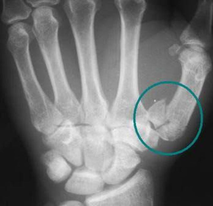 Name the fracture