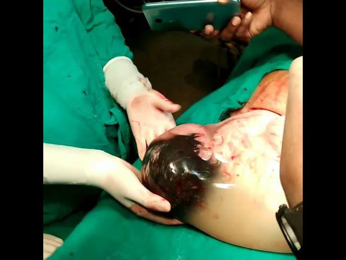 'en caul' birth- baby born with the amniotic sac