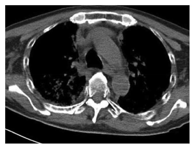 Pulmonary Toxicity Induced by Bortezomib in 64-Year-Old