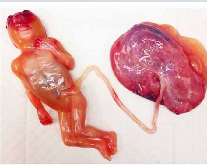 MEDizzy - #Spontaneous abortion at 16 weeks was suffering fr