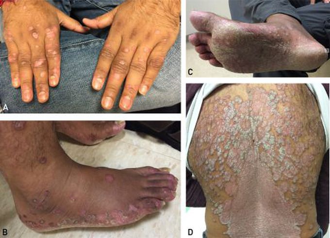 Signs and Symptoms of Chikungunya