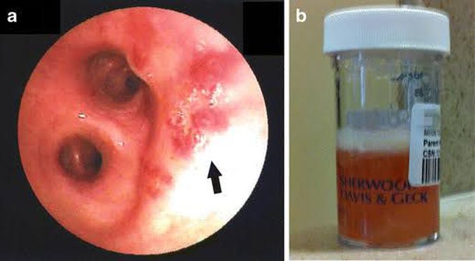 Pseudohaemoptysis