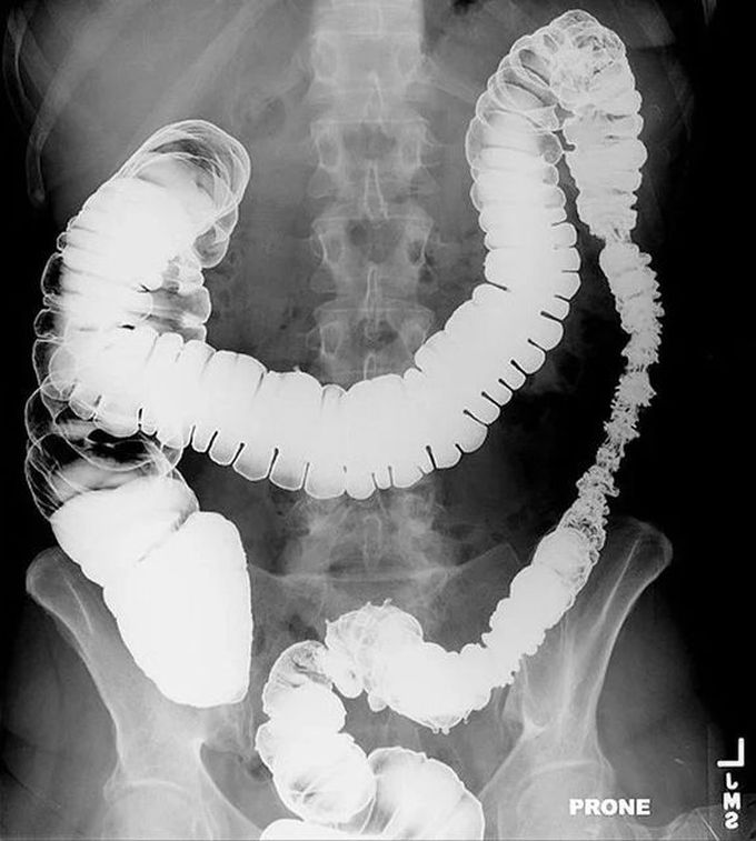 Barium Enema