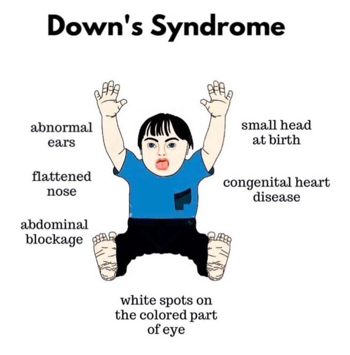 Down Syndrome - MEDizzy