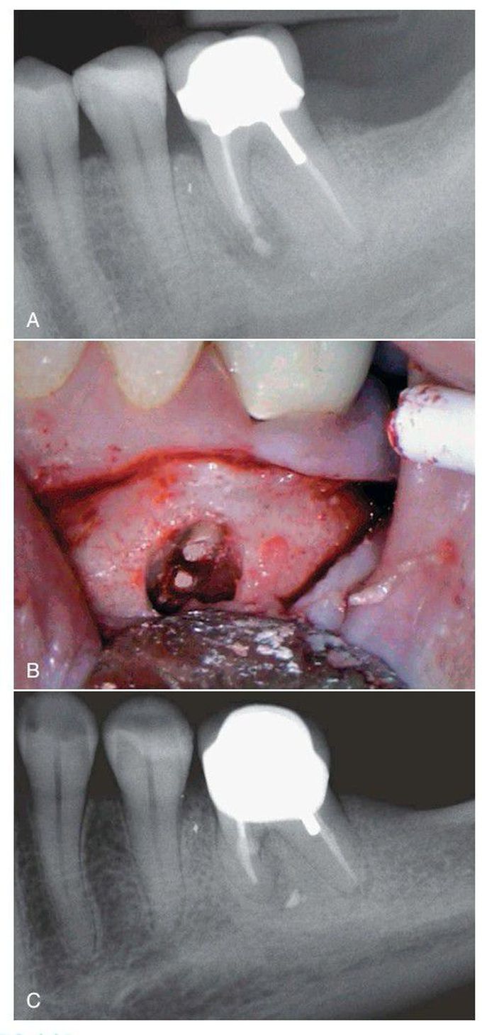 Vertical root fracture