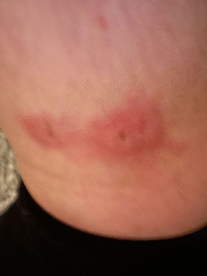 Help identifying what type a bite this is