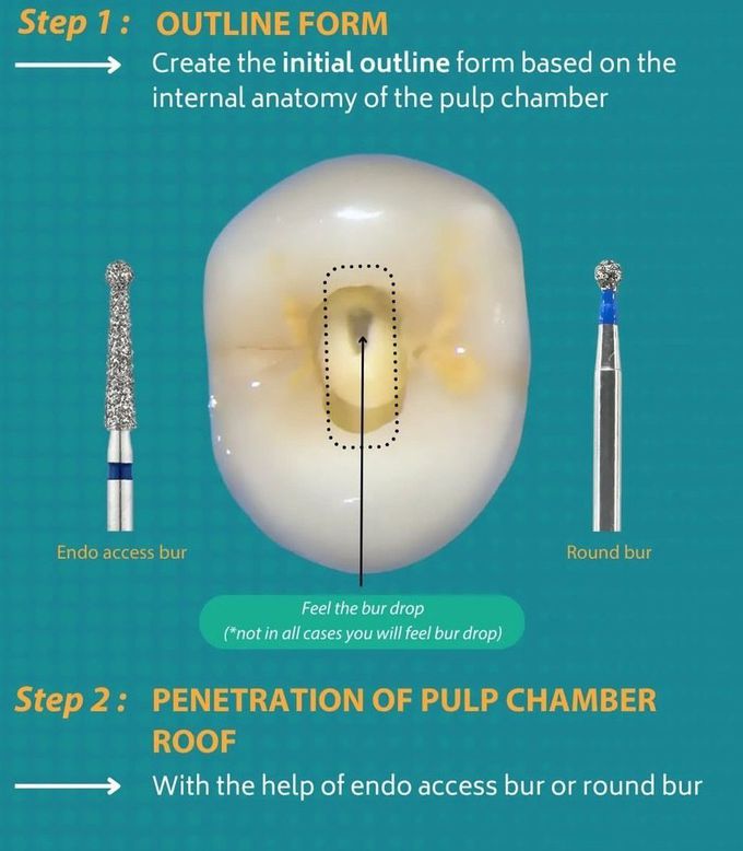 Access Cavity Prep I