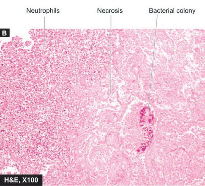 Lung abscess