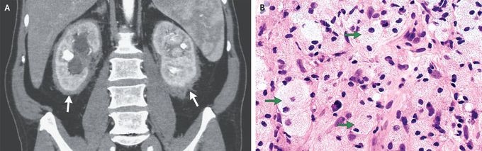 “Hairy Kidney” in Erdheim–Chester Disease