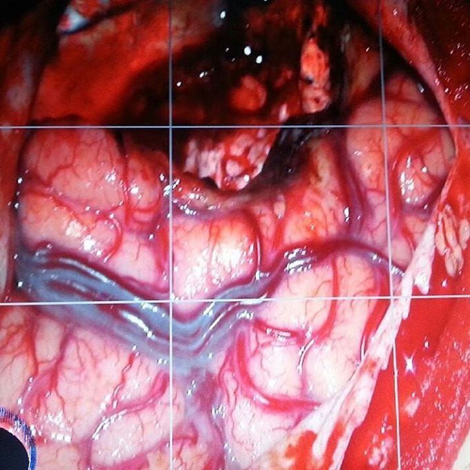 Temporal lobe resection in patient with interactable epilepsy