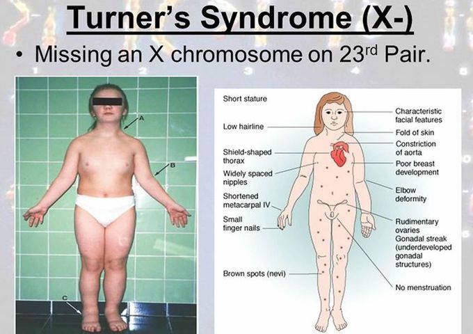 turner syndrome chromosome