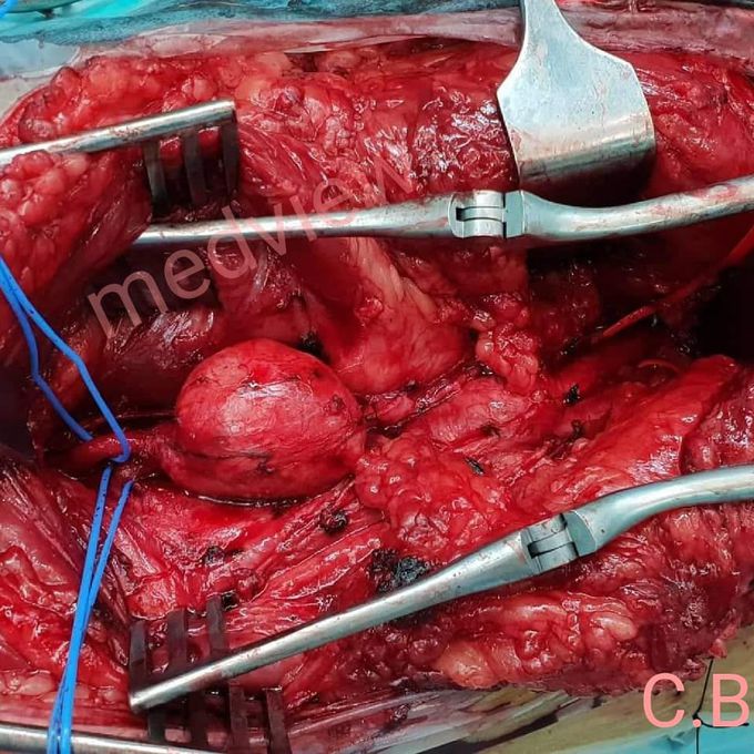 Popliteal artery aneurysm