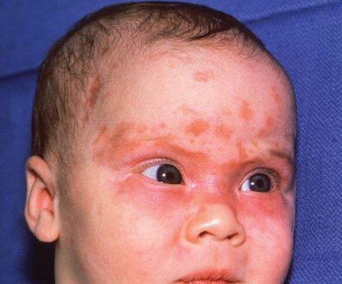 In the given picture, diagnose patients based on their dermatologic presentations.
 1) Transient neonatal pustular melanosis
 2) Erythema toxicum neonatorum
 3) Neonatal lupus erythematosus
 4) Neonatal cephalic pustulosis
 5) Subcutaneous fat necrosis of the newborn

 Diagnosis ?