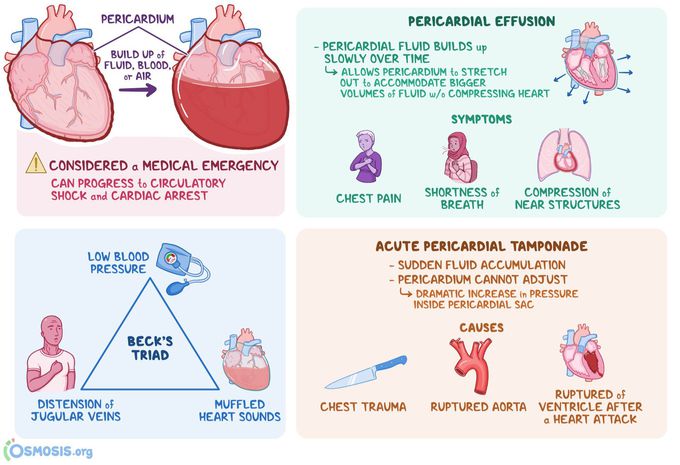 Cardiac tamponade